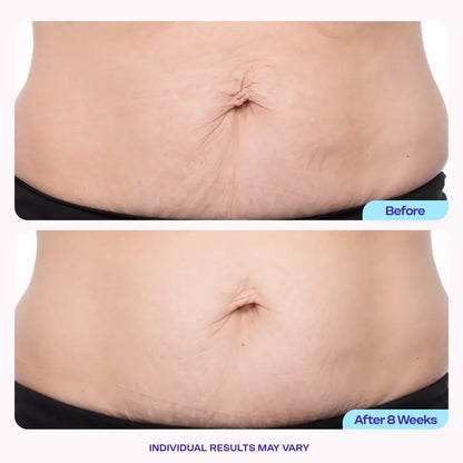 Tighten & Smooth Belly Firming Cream – Cryo Thermo Body Gel for Cellulite, Stretch Marks & Loose-Looking Skin